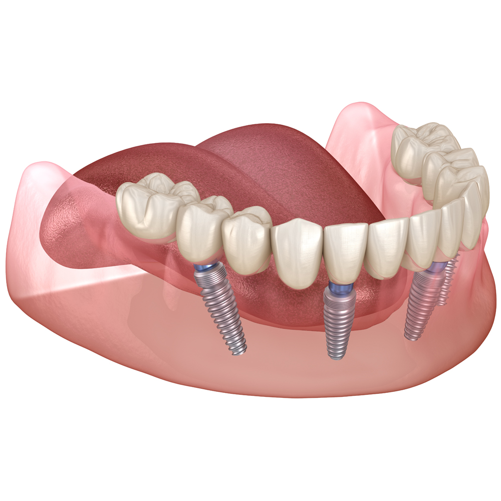Восстановление зубного ряда All‑on‑4