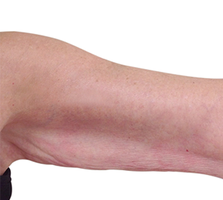 Термомагнитное омоложение рук (после процедуры)