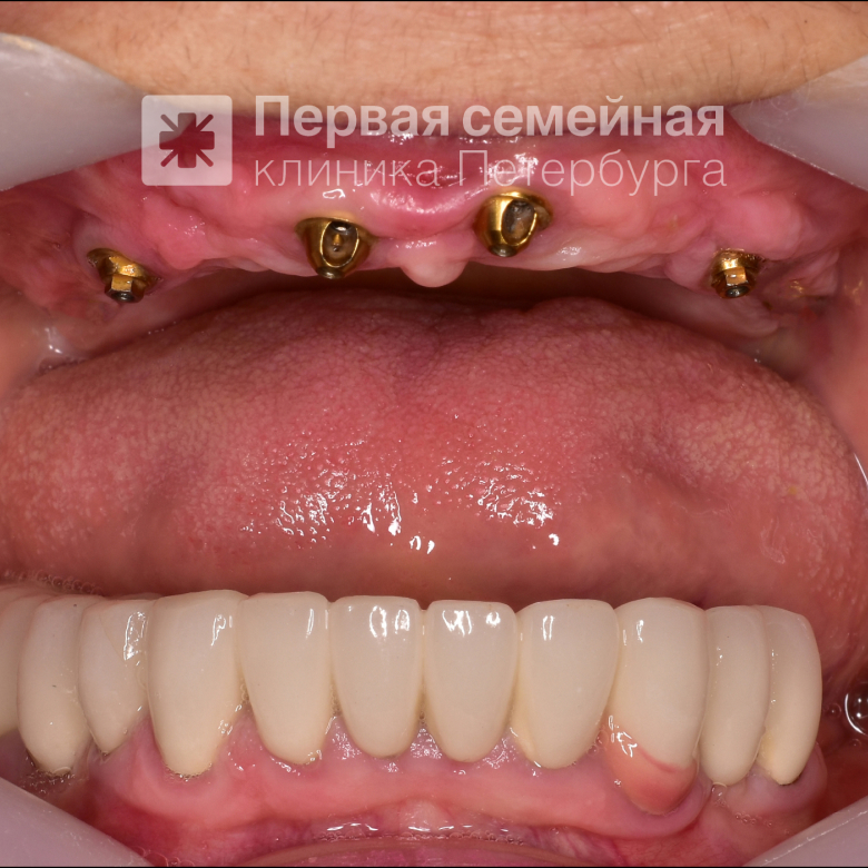 Восстановление зубного ряда "All-on-4" (до процедуры)