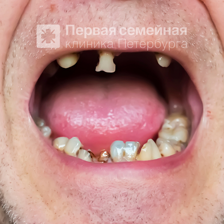 Методика восстановления зубного ряда на четырех имплантатах "All-on-4" (до процедуры)