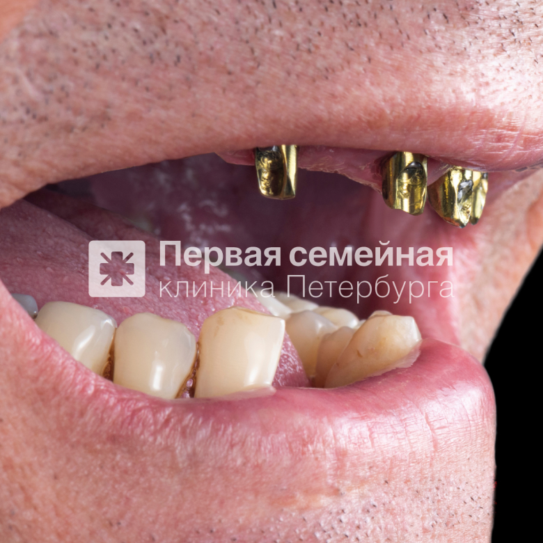 Восстановление зубного ряда методом "All-on-4" (до процедуры)