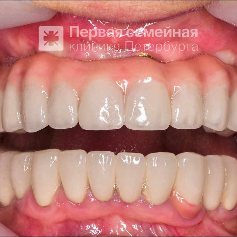 Восстановление зубного ряда "All-on-4" (после процедуры)