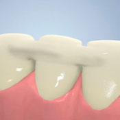 Шинирование зубов гибкой керамикой