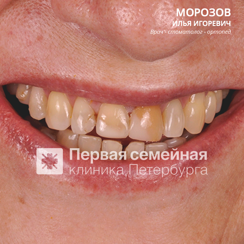 Установка виниров (до процедуры)