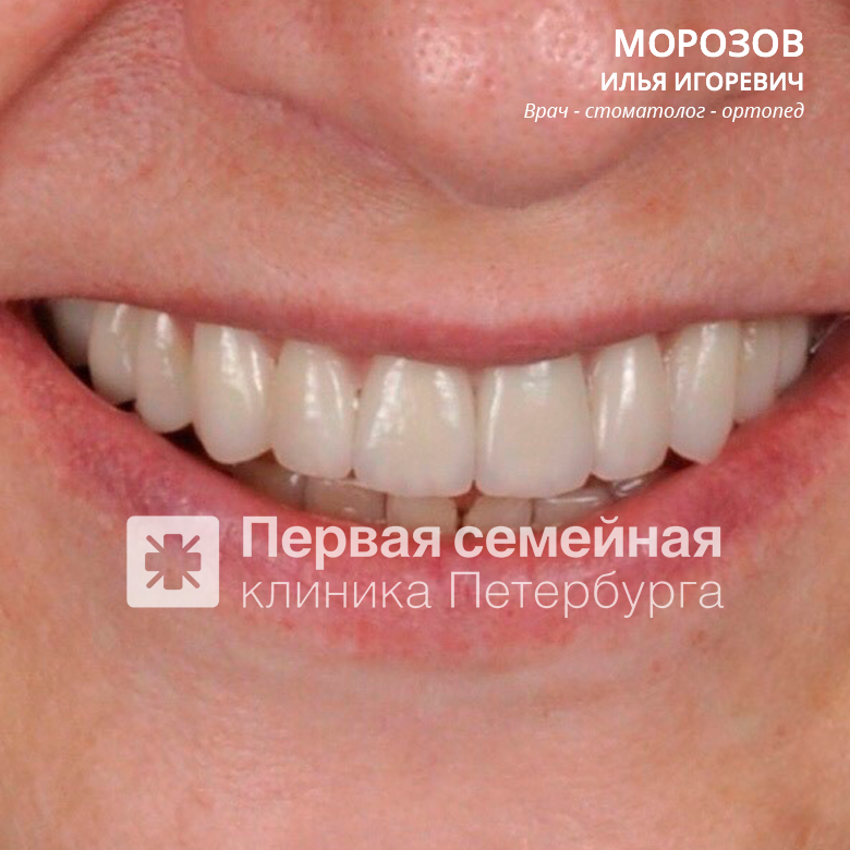 Установка виниров (после процедуры)