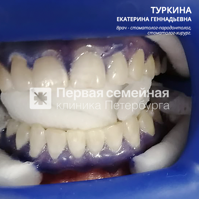 Фотографии до и после лазерного отбеливания (после процедуры)