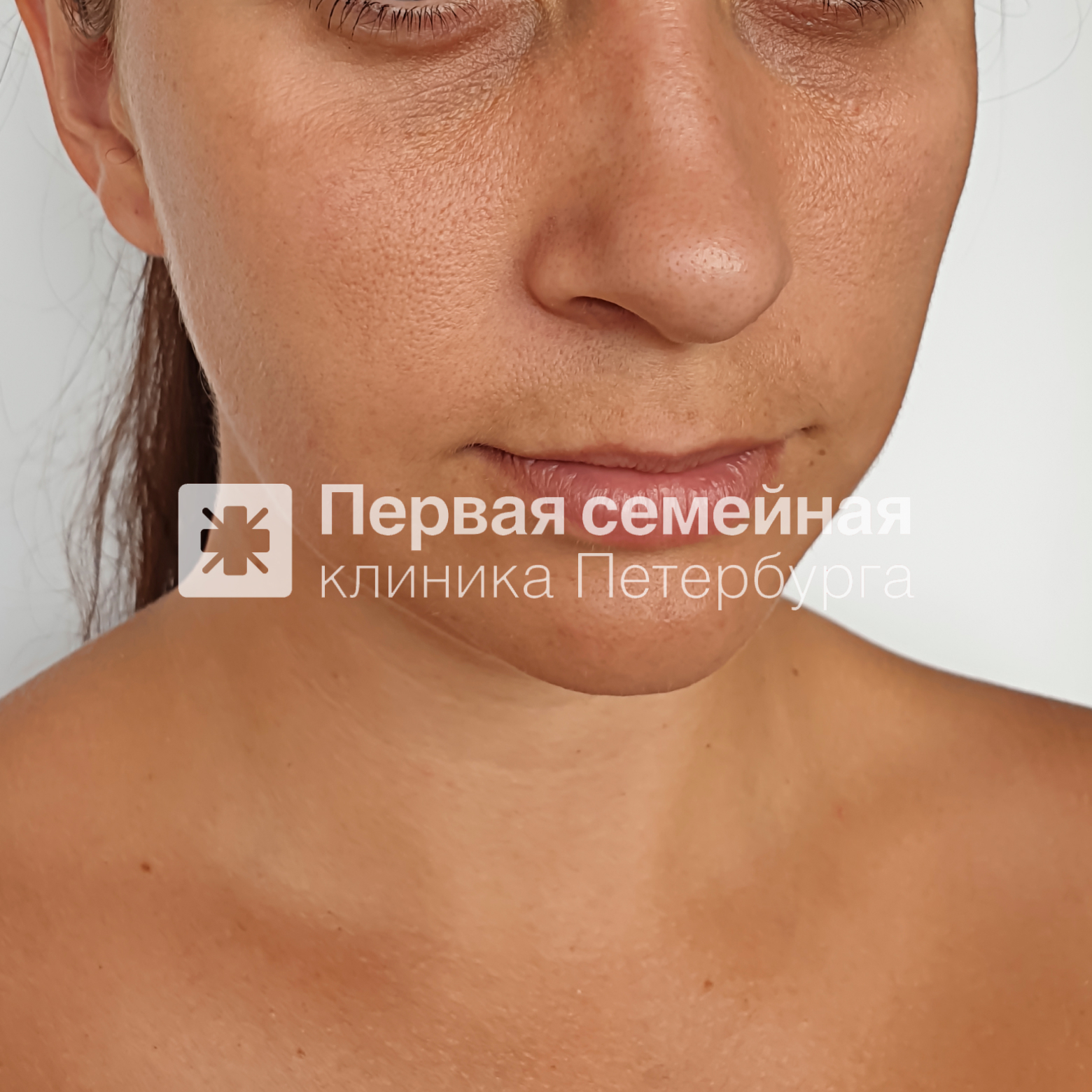Подтяжка нижней части лица нитями Aptos (до процедуры)