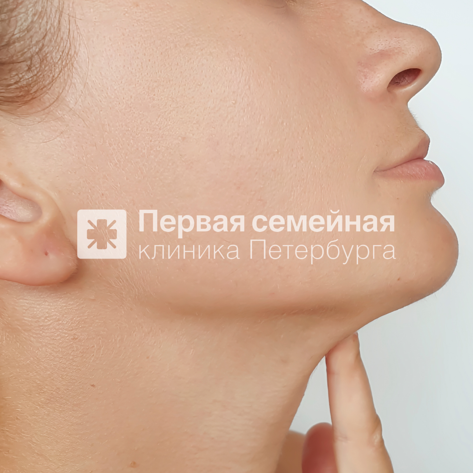 Нитевая коррекция подбородка (после процедуры)
