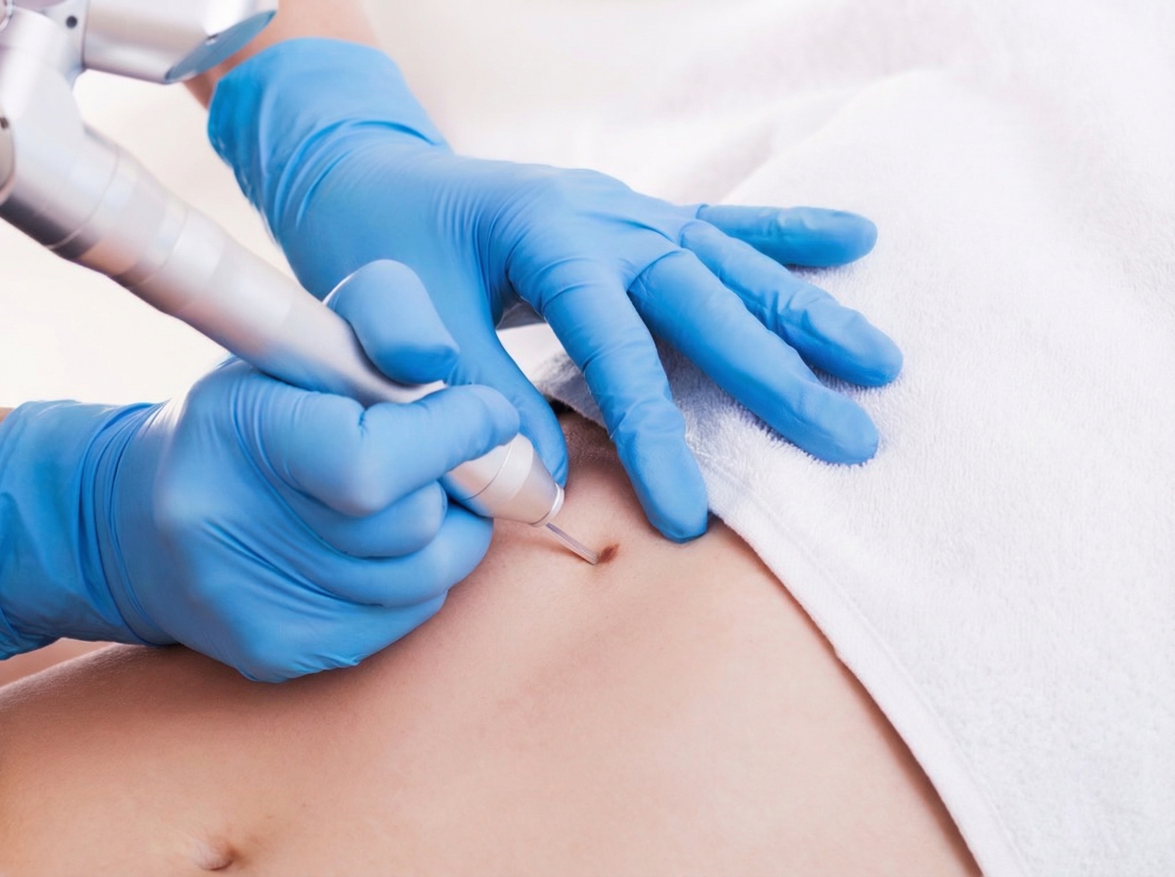 Удаление родинок, кератом, бородавок, папиллом