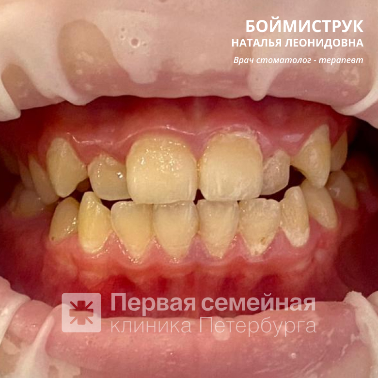 Профгигиена полости рта у детей (до процедуры)