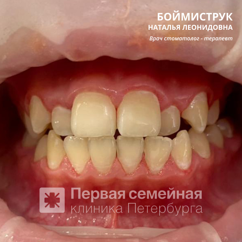 Профгигиена полости рта у детей (после процедуры)