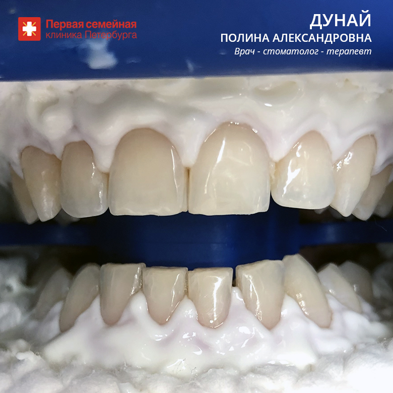 Отбеливание на 8-12 тонов (до процедуры)