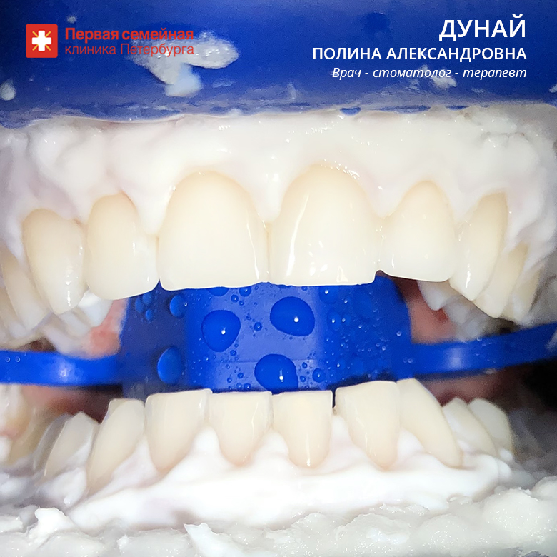 Отбеливание на 8-12 тонов (после процедуры)