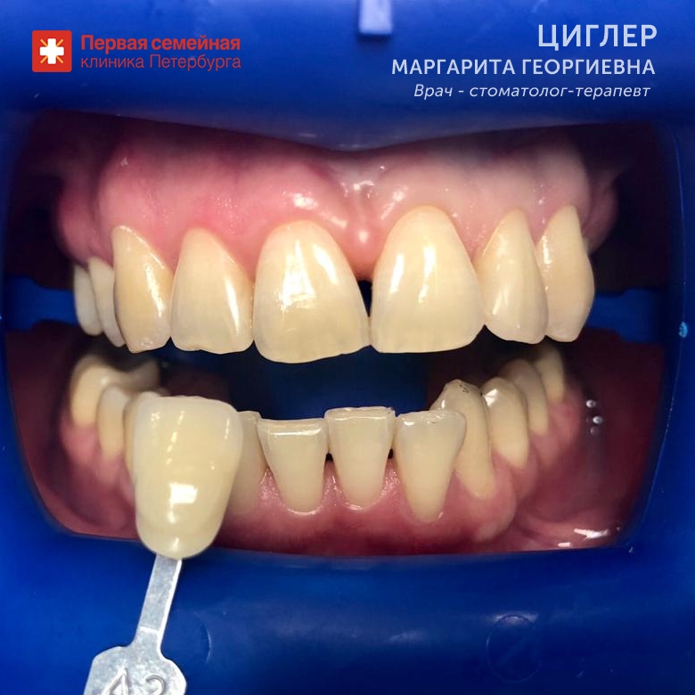 Отбеливание на два тона (до процедуры)
