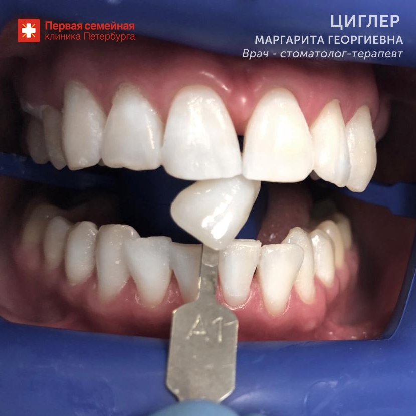 Отбеливание на два тона (после процедуры)