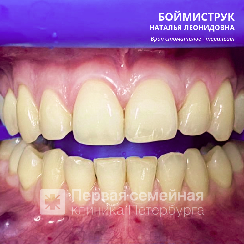 Отбеливание ZOOM-4 на несколько тонов (до процедуры)