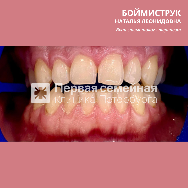Отбеливание ZOOM-4 (до процедуры)