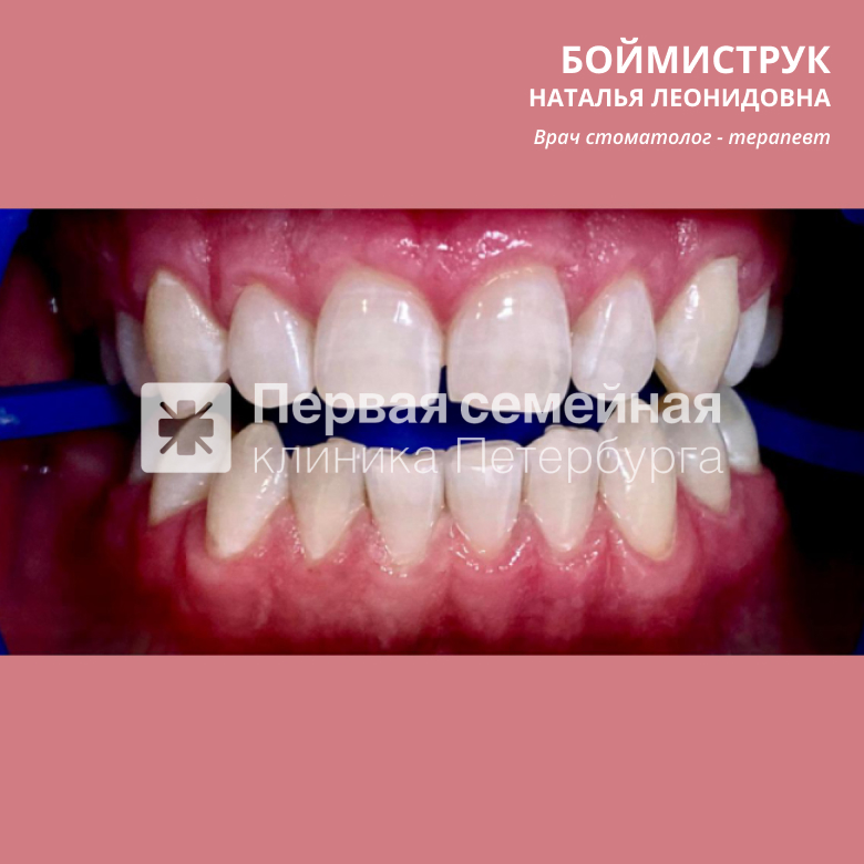 Отбеливание ZOOM-4 (после процедуры)