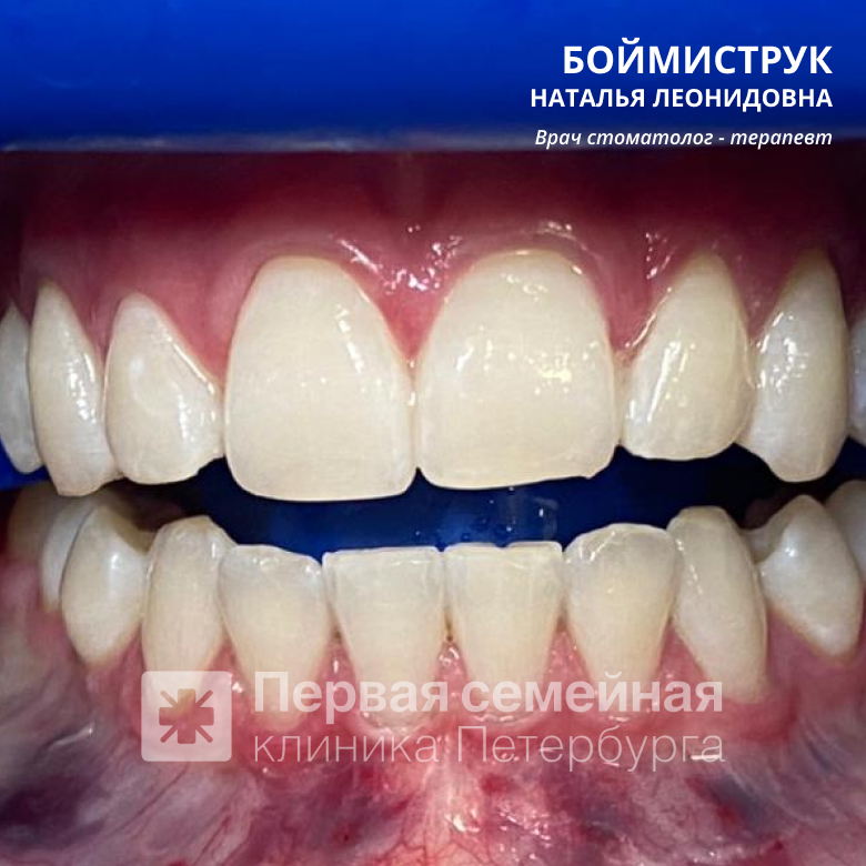 Отбеливание ZOOM-4 на несколько тонов (после процедуры)