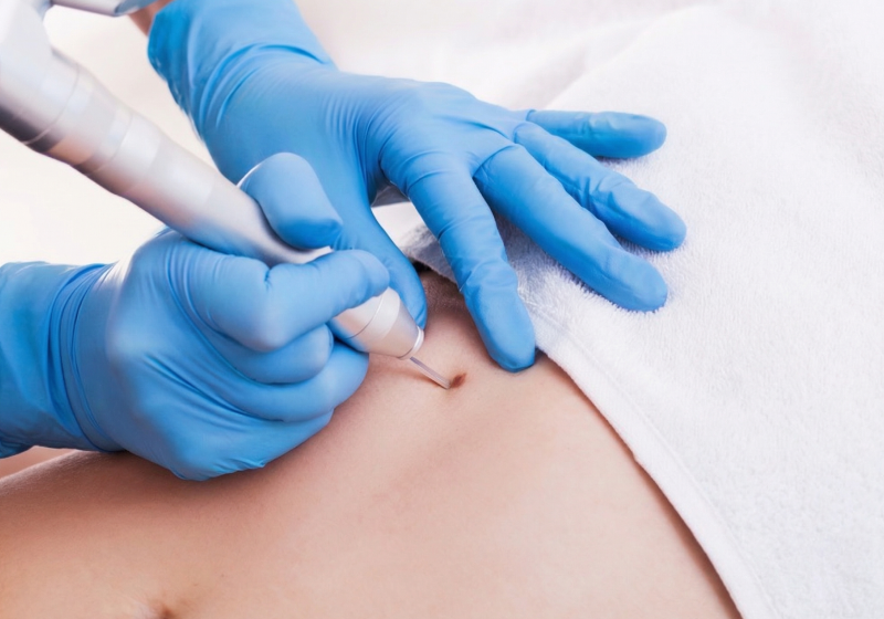 Удаление родинок, бородавок, папиллом