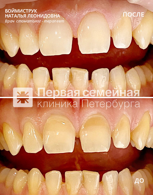 Клиновидный дефект: пример работы 2