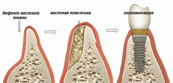 Схема имплантации